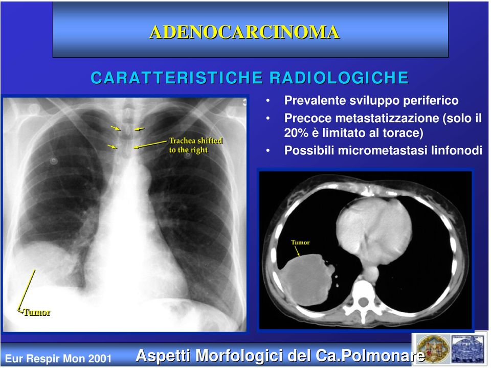 20% è limitato al torace) Possibili micrometastasi