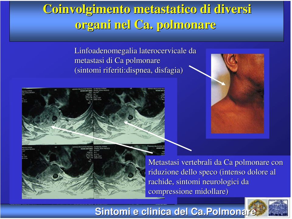 . polmonare Linfoadenomegalia laterocervicale da metastasi di Ca polmonare (sintomi