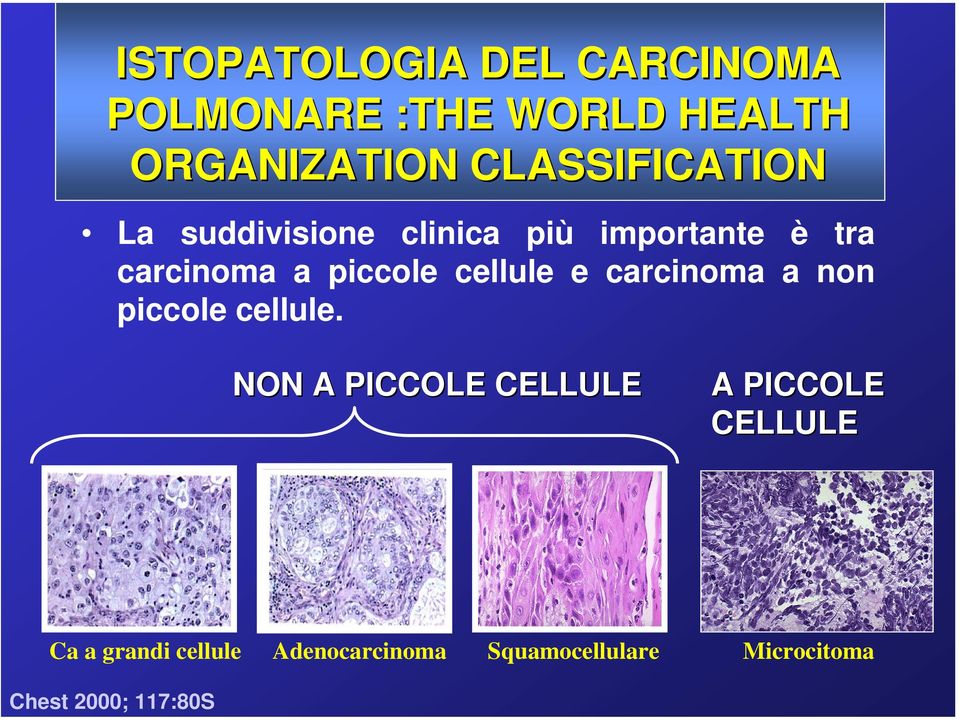 carcinoma a piccole cellule e carcinoma a non piccole cellule.
