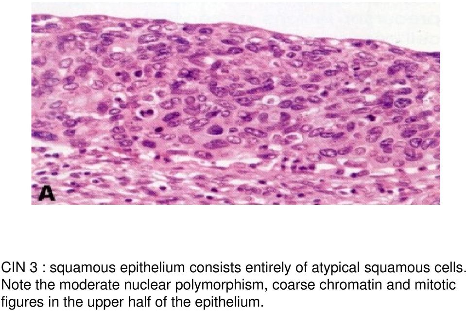 Note the moderate nuclear polymorphism, coarse