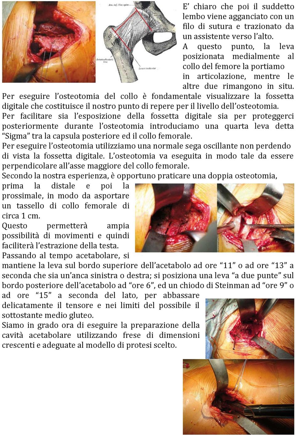 Per eseguire l osteotomia del collo è fondamentale visualizzare la fossetta digitale che costituisce il nostro punto di repere per il livello dell osteotomia.