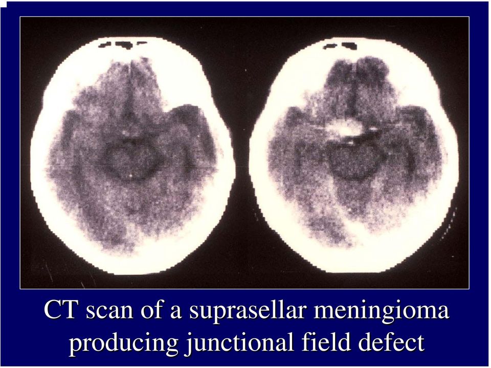 meningioma