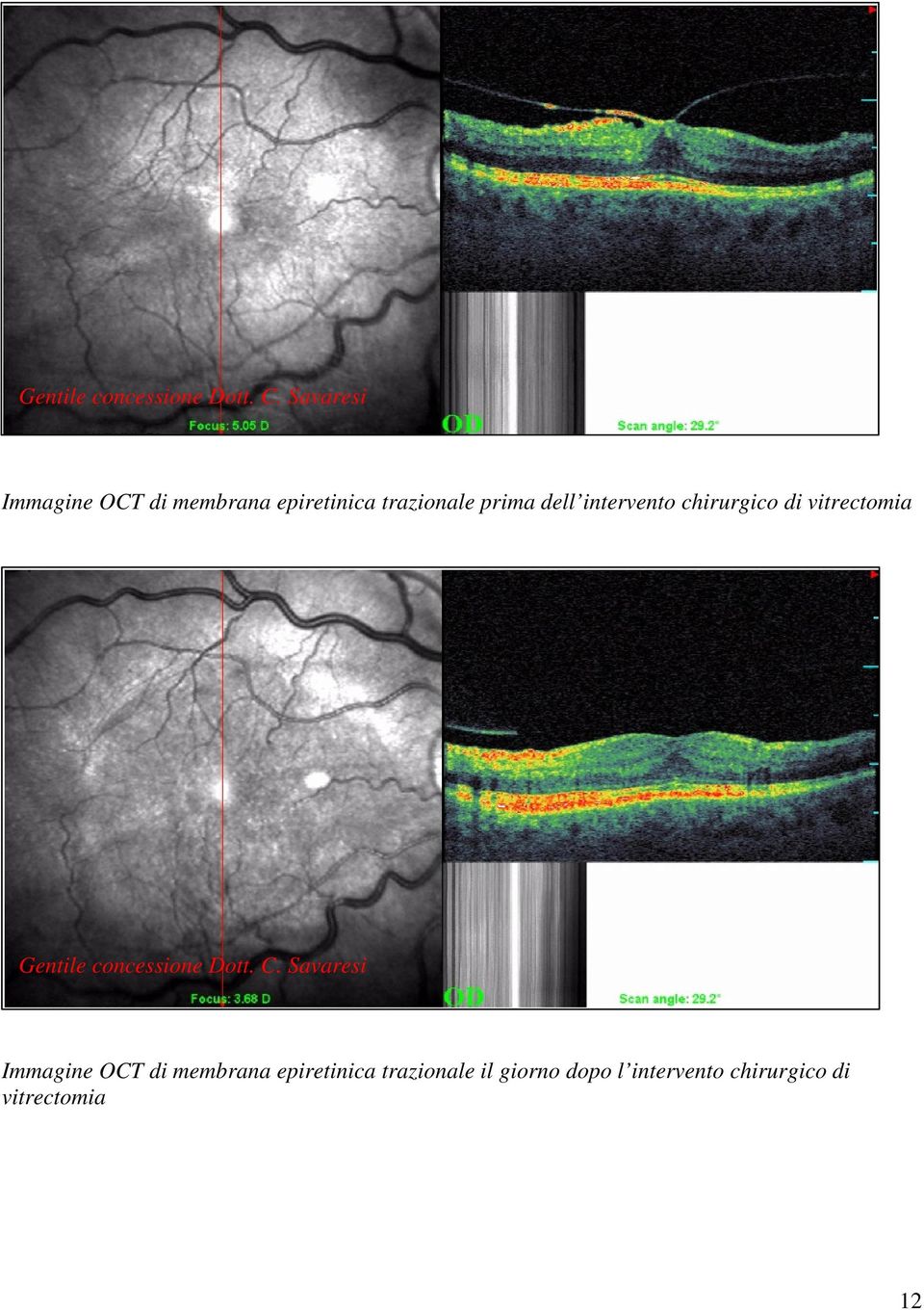intervento chirurgico di vitrectomia  Savaresi Immagine OCT di