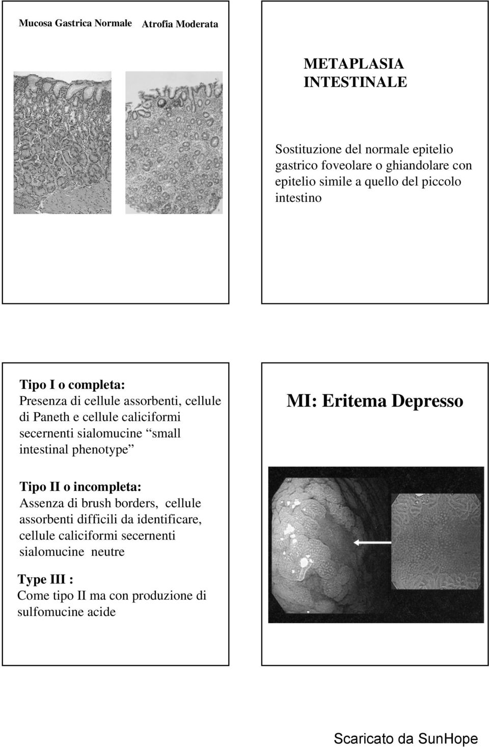 secernenti sialomucine small intestinal phenotype MI: Eritema Depresso Tipo II o incompleta: Assenza di brush borders, cellule assorbenti