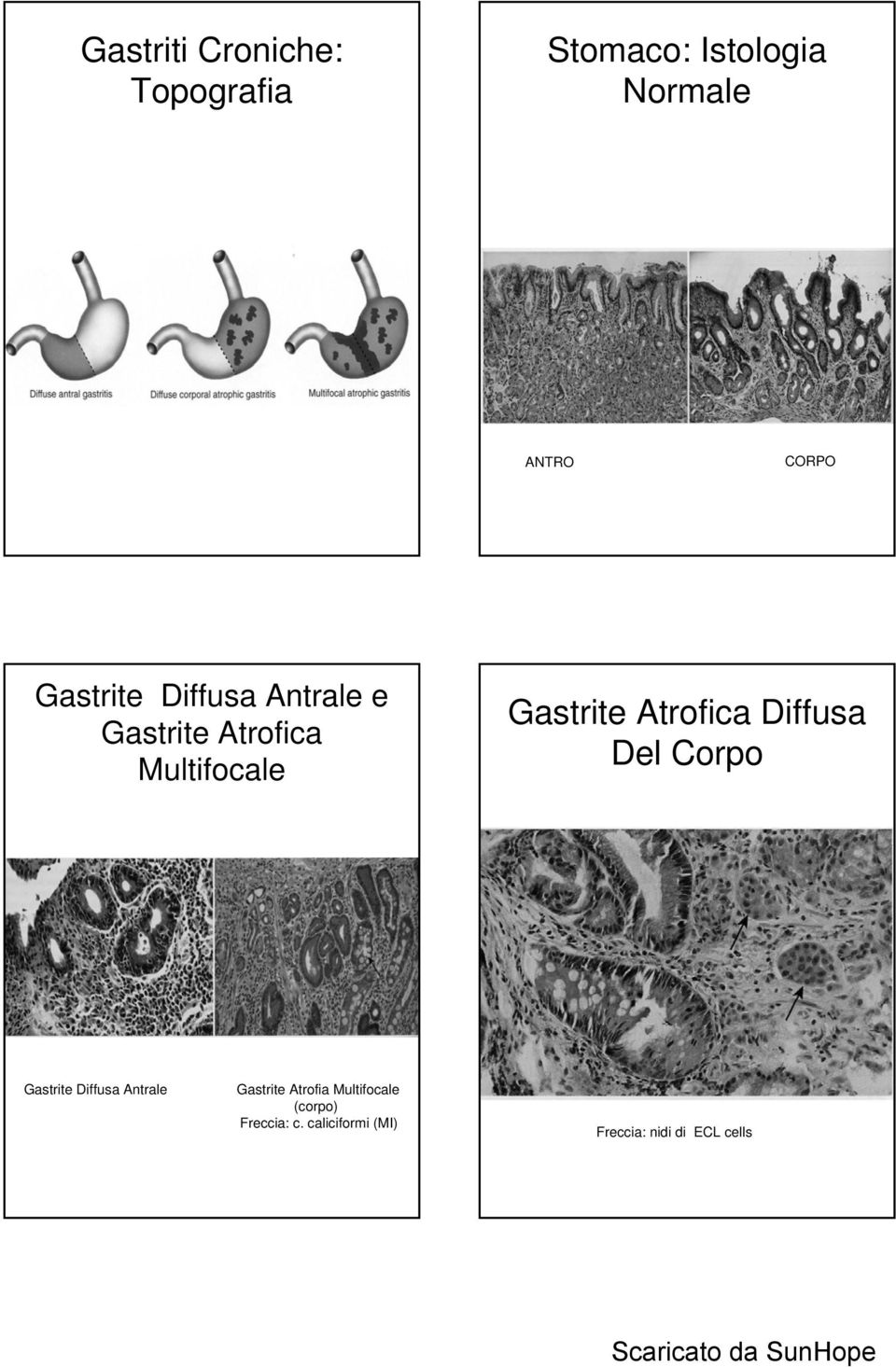 Atrofica Diffusa Del Corpo Gastrite Diffusa Antrale Gastrite Atrofia