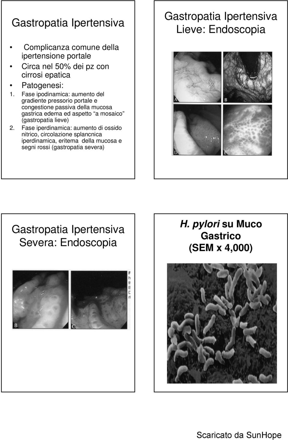 Fase ipodinamica: aumento del gradiente pressorio portale e congestione passiva della mucosa gastrica edema ed aspetto a mosaico