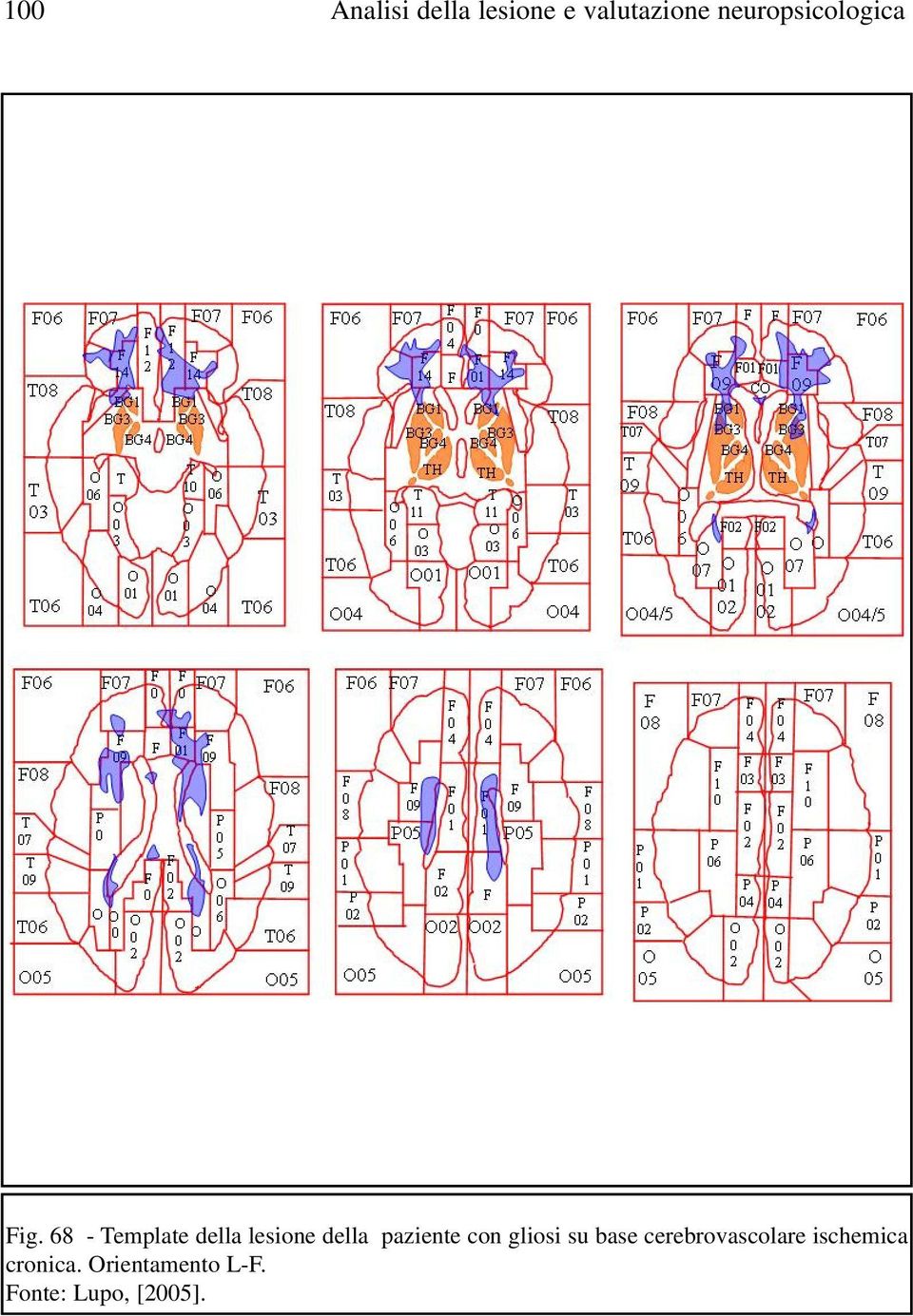 68 - emplate della lesione della paziente con