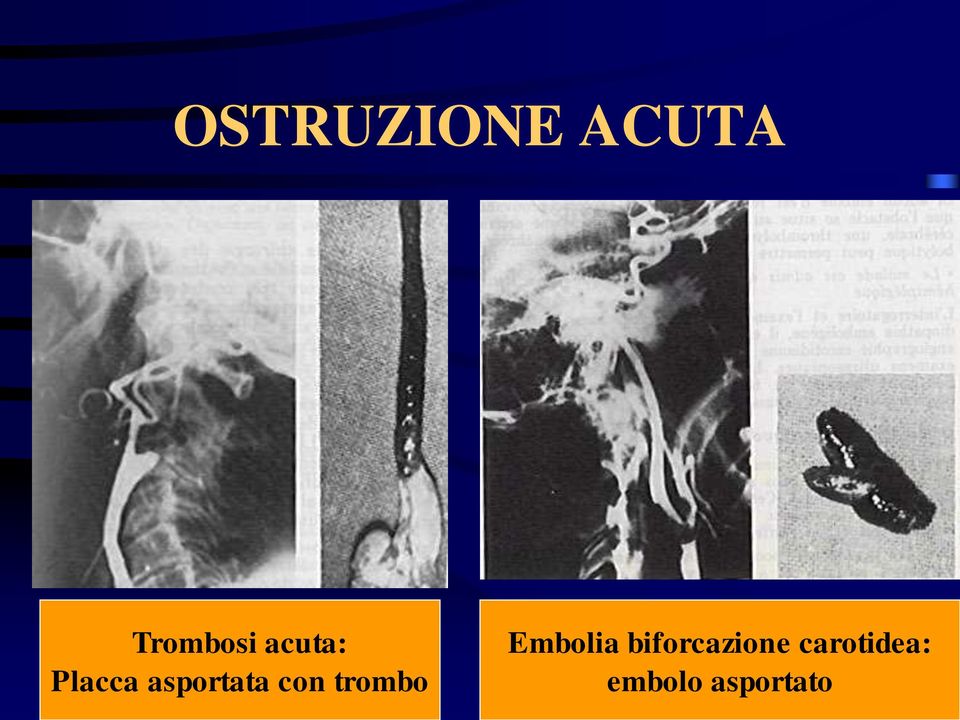 trombo Embolia biforcazione