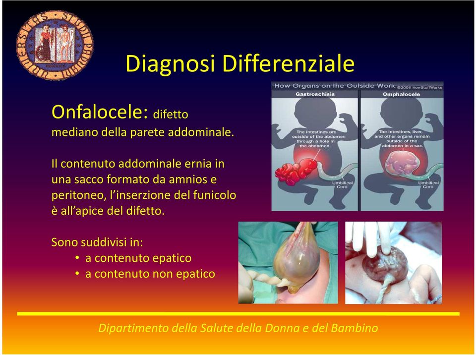 Il contenuto addominale ernia in una sacco formato da amnios e