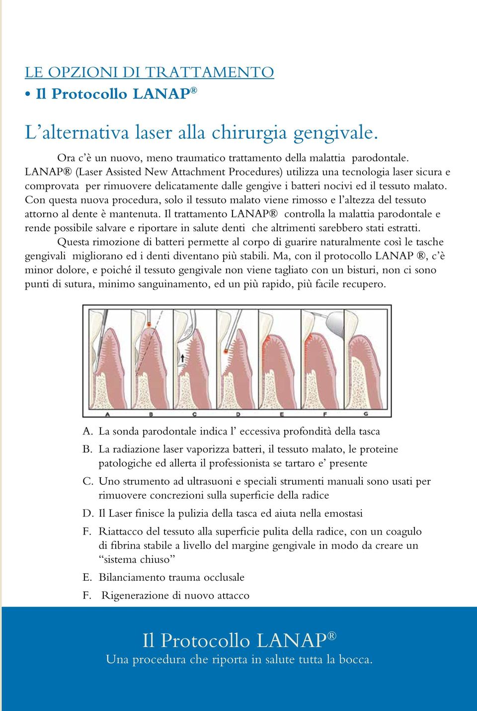 Con questa nuova procedura, solo il tessuto malato viene rimosso e l altezza del tessuto attorno al dente è mantenuta.