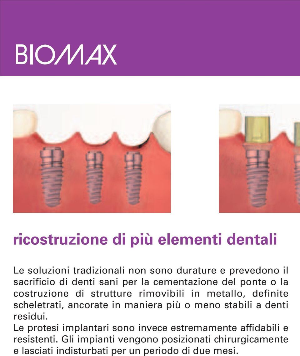 scheletrati, ancorate in maniera più o meno stabili a denti residui.