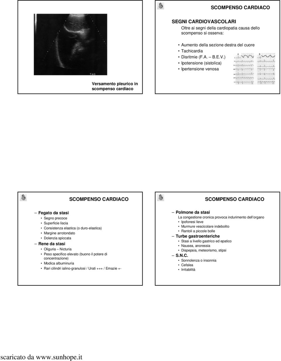 ) Ipotensione (sistolica) Ipertensione venosa Versamento pleurico in scompenso cardiaco Fegato da stasi Segno precoce Superficie liscia Consistenza elastica (o duro-elastica) Margine arrotondato