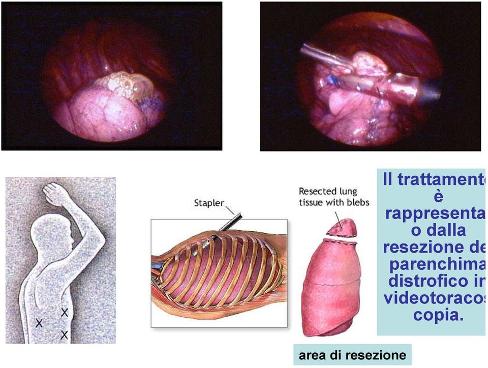 dalla resezione de