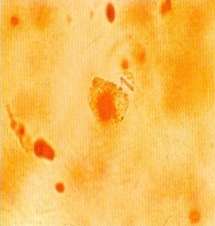 Malattia da Deposito di Cristalli di Idrossiapatite i cristalli di idrossiapatite (calcio fosfato, calcio carbonato) si depositano nella cartilagine, nella membrana sinoviale, nelle capsule, nei