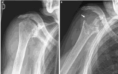 An 85-year-old woman presented with right shoulder pain and swelling and a large hematoma extending into the chest wall.