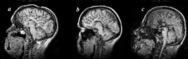 Diagnosi 3/18 Dati clinici Encefalopatia severa Ipotonia Crisi