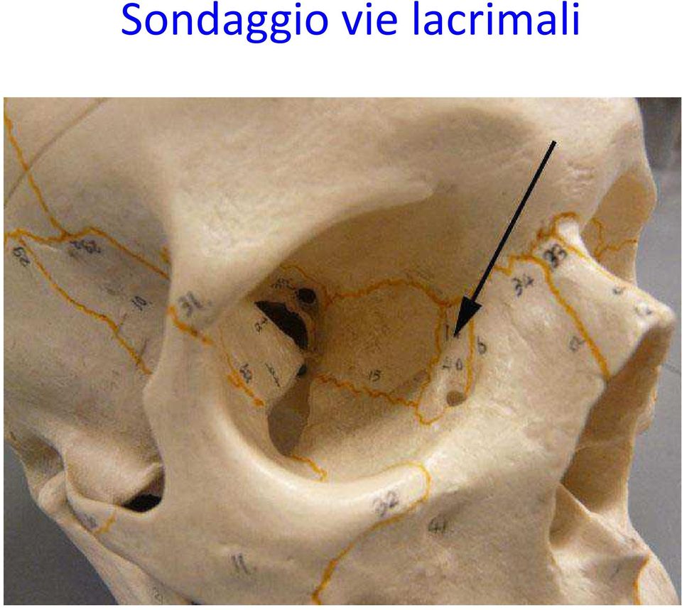 lacrimali