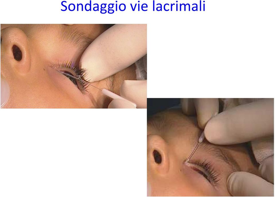 lacrimali