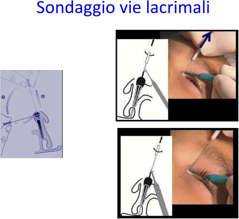 lacrimali