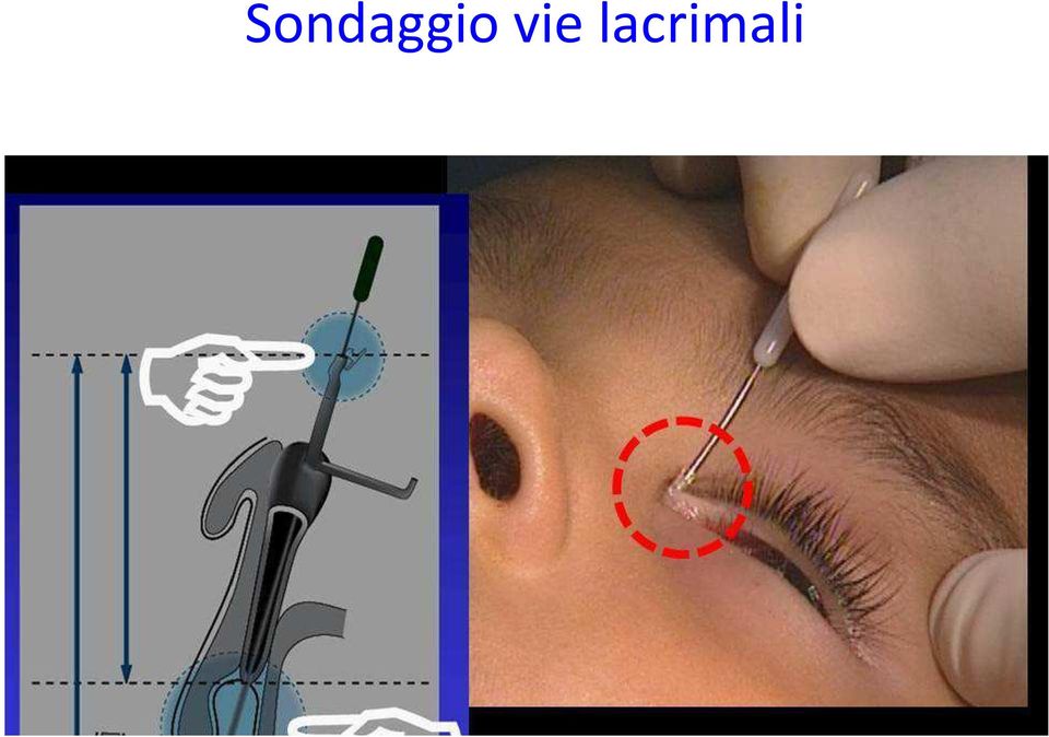 lacrimali