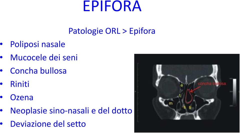 Patologie ORL > Epifora Neoplasie