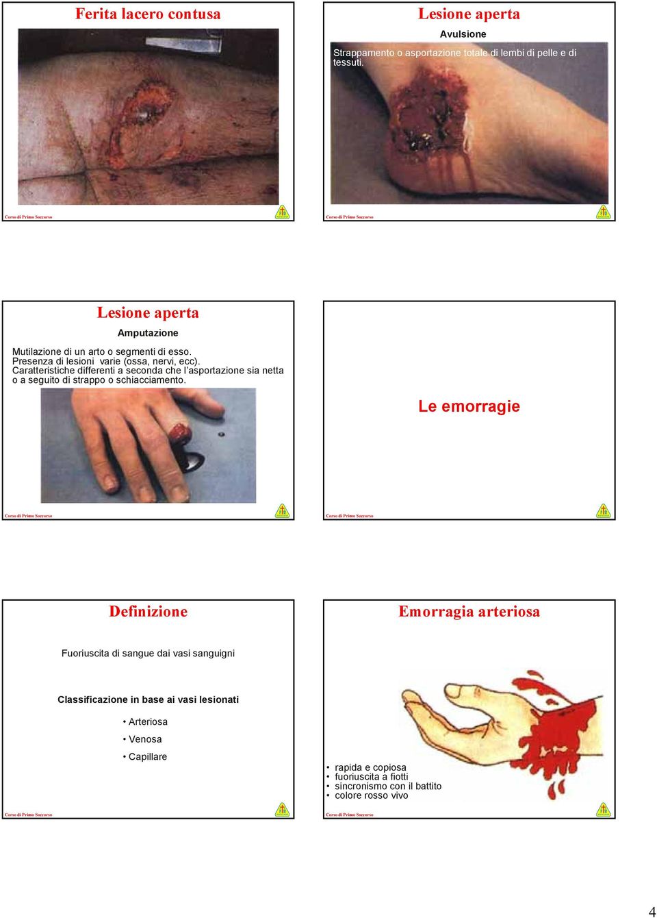 Caratteristiche differenti a seconda che l asportazione sia netta o a seguito di strappo o schiacciamento.