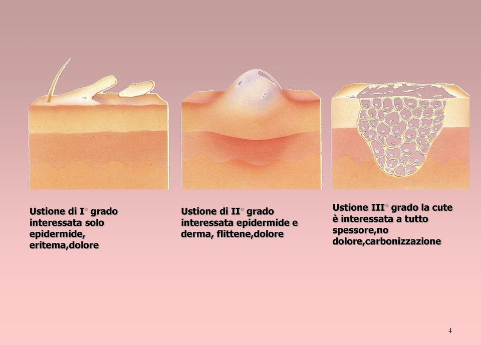 epidermide e derma, flittene,dolore Ustione III grado