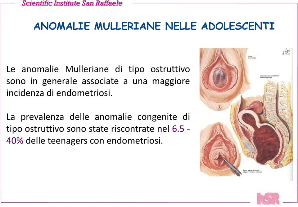 endometriosi.