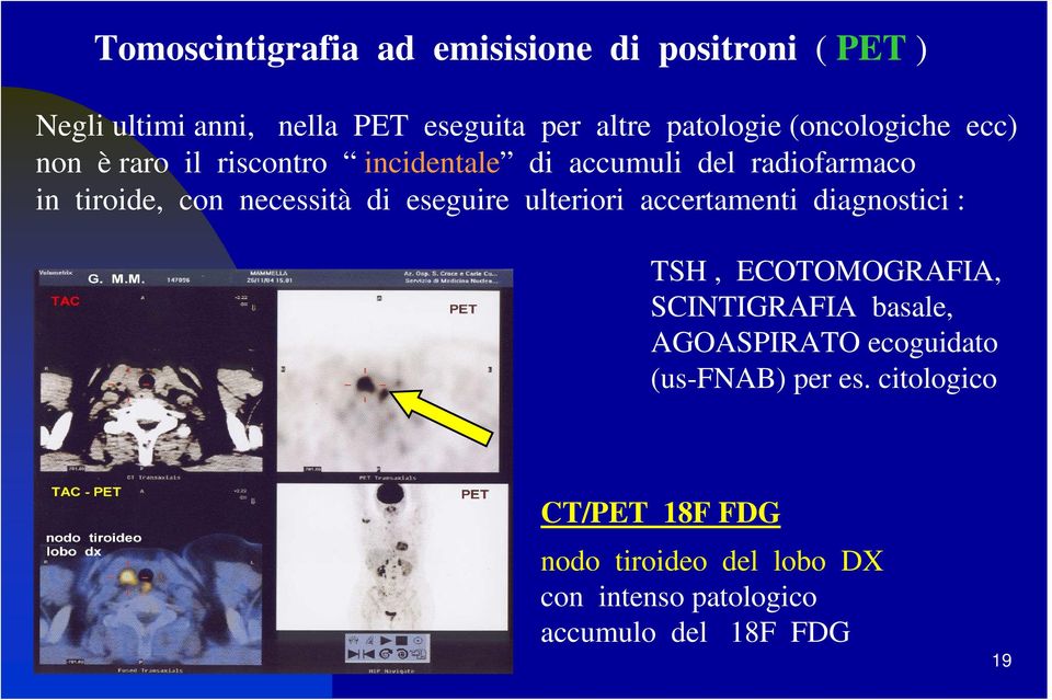 eseguire ulteriori accertamenti diagnostici : TSH, ECOTOMOGRAFIA, SCINTIGRAFIA basale, AGOASPIRATO ecoguidato