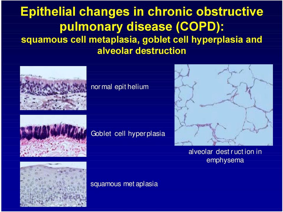 and alveolar destruction normal epithelium Goblet cell