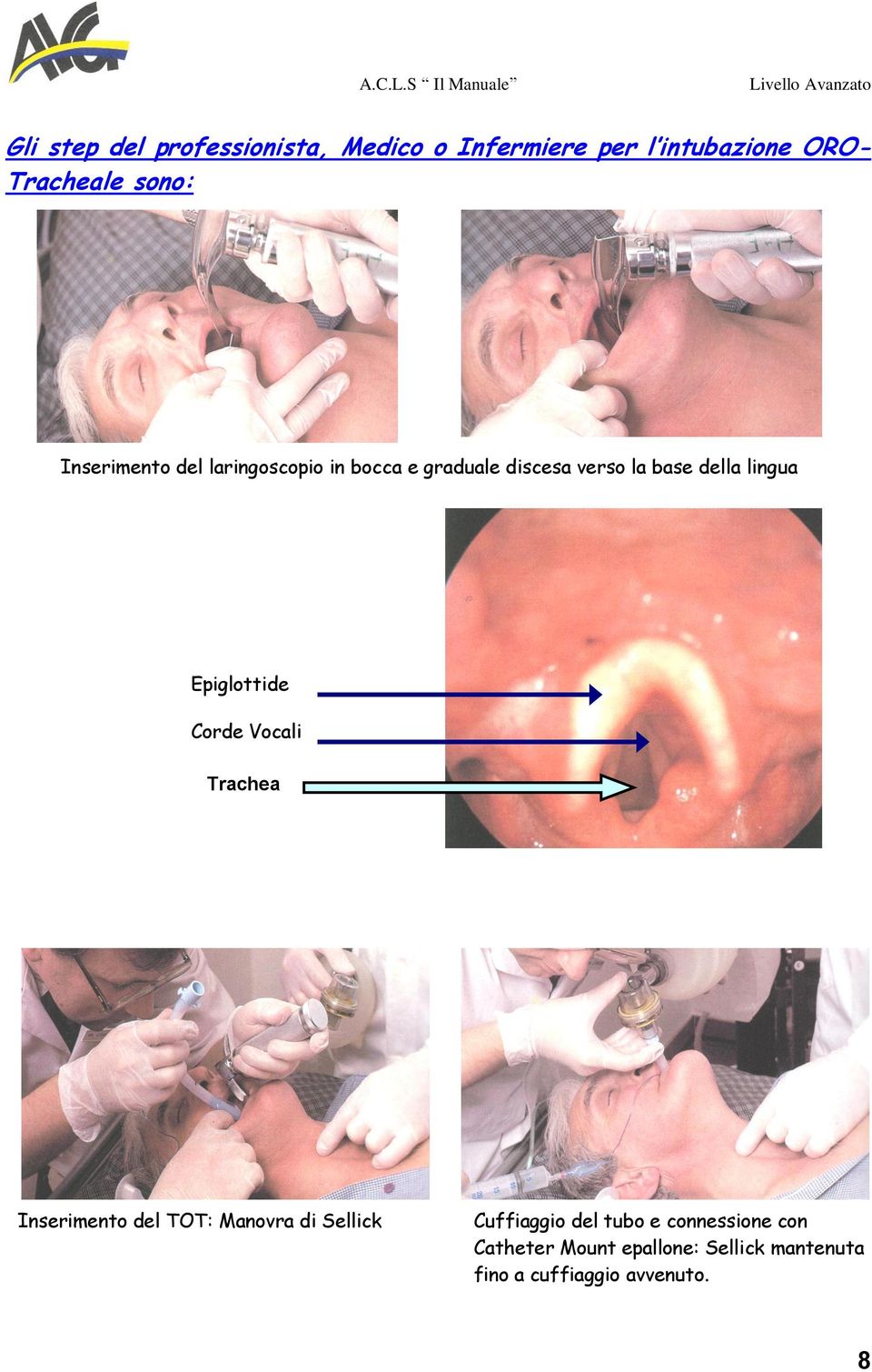 Epiglottide Corde Vocali Trachea Inserimento del TOT: Manovra di Sellick Cuffiaggio del