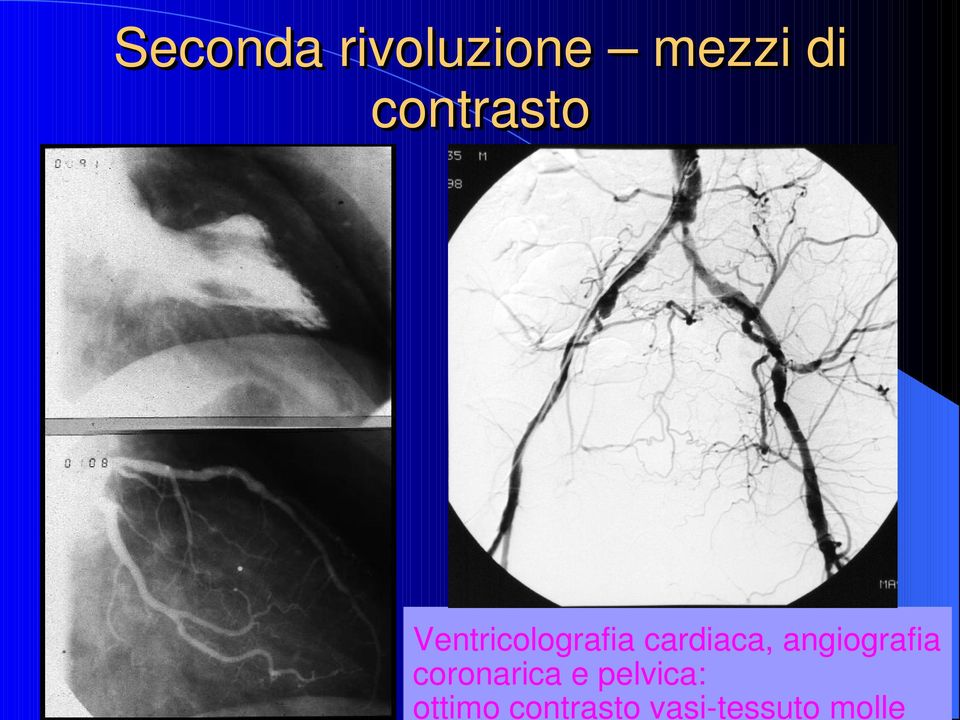 cardiaca, angiografia coronarica