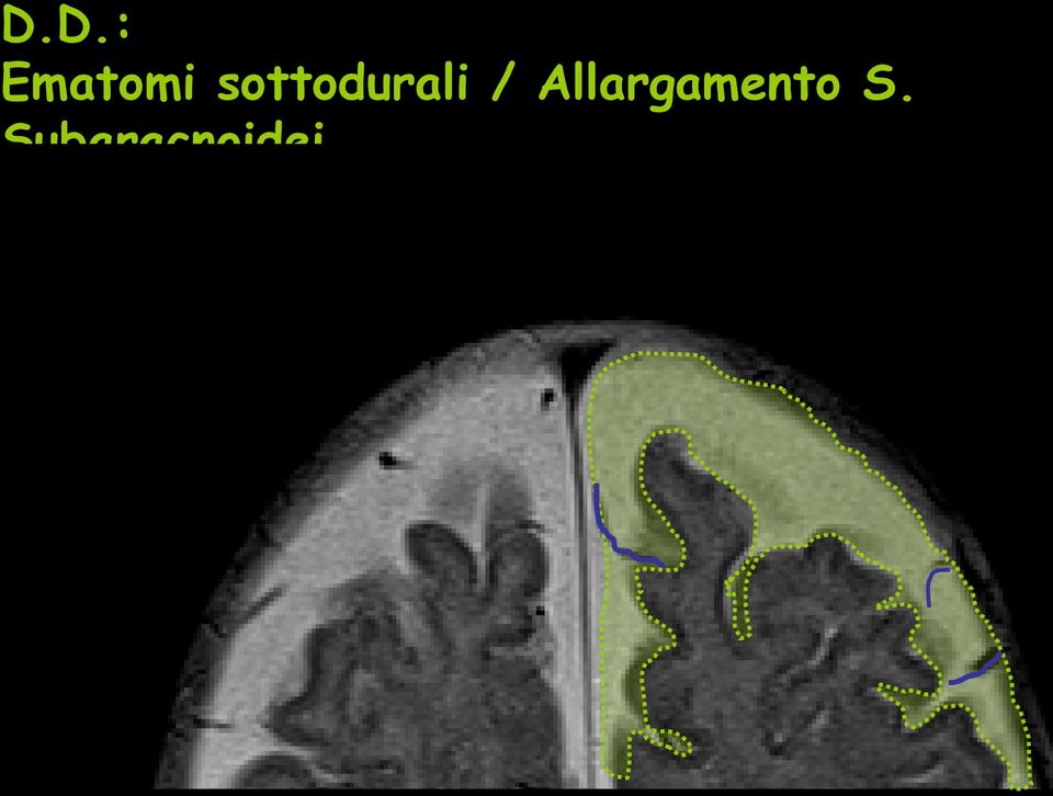 assorbimento liquorale per immaturità granulazioni