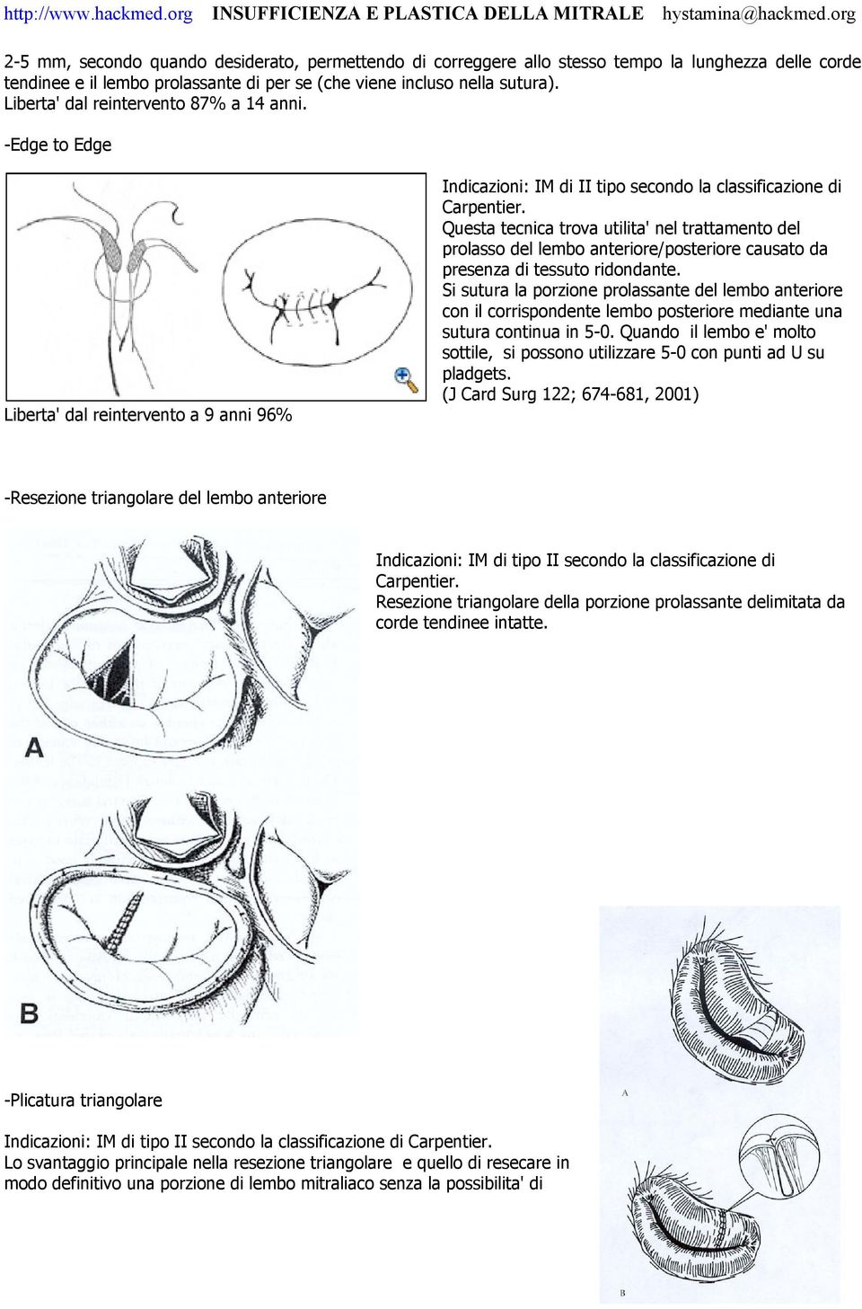 Questa tecnica trova utilita' nel trattamento del prolasso del lembo anteriore/posteriore causato da presenza di tessuto ridondante.