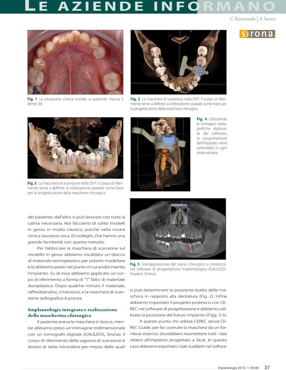 4 Utilizzando le immagini radiografiche elaborate dal software, la progettazione dell impianto viene controllata in ogni strato ed asse. Fig.