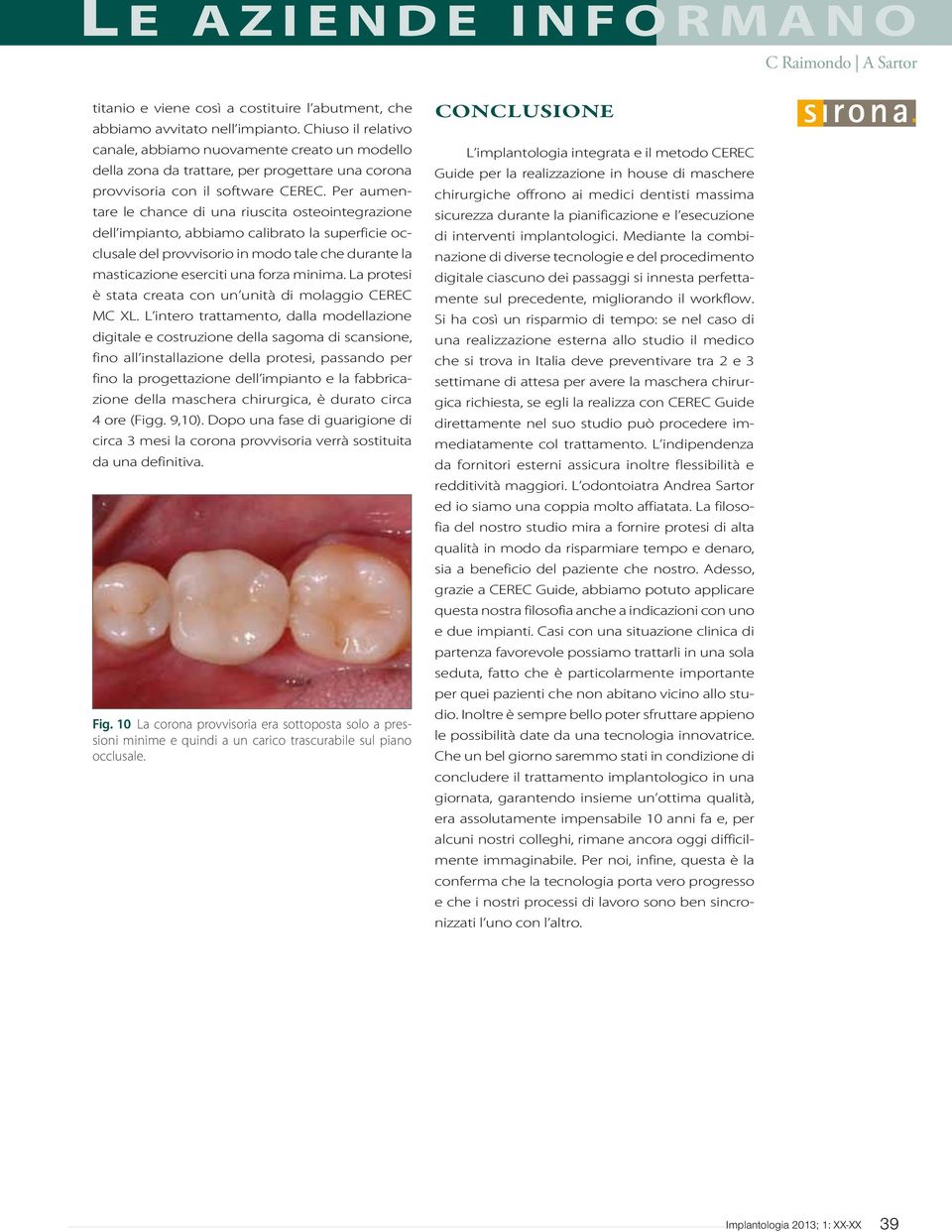 Per aumentare le chance di una riuscita osteointegrazione dell impianto, abbiamo calibrato la superficie occlusale del provvisorio in modo tale che durante la masticazione eserciti una forza minima.