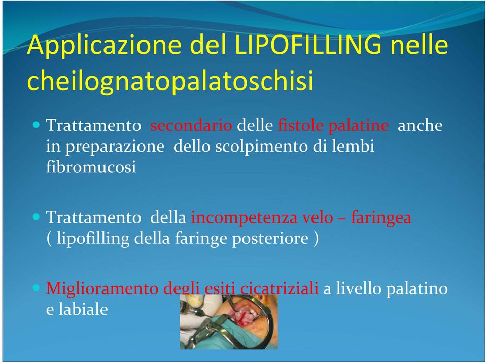 lembi fibromucosi Trattamento della incompetenza velo faringea ( lipofilling