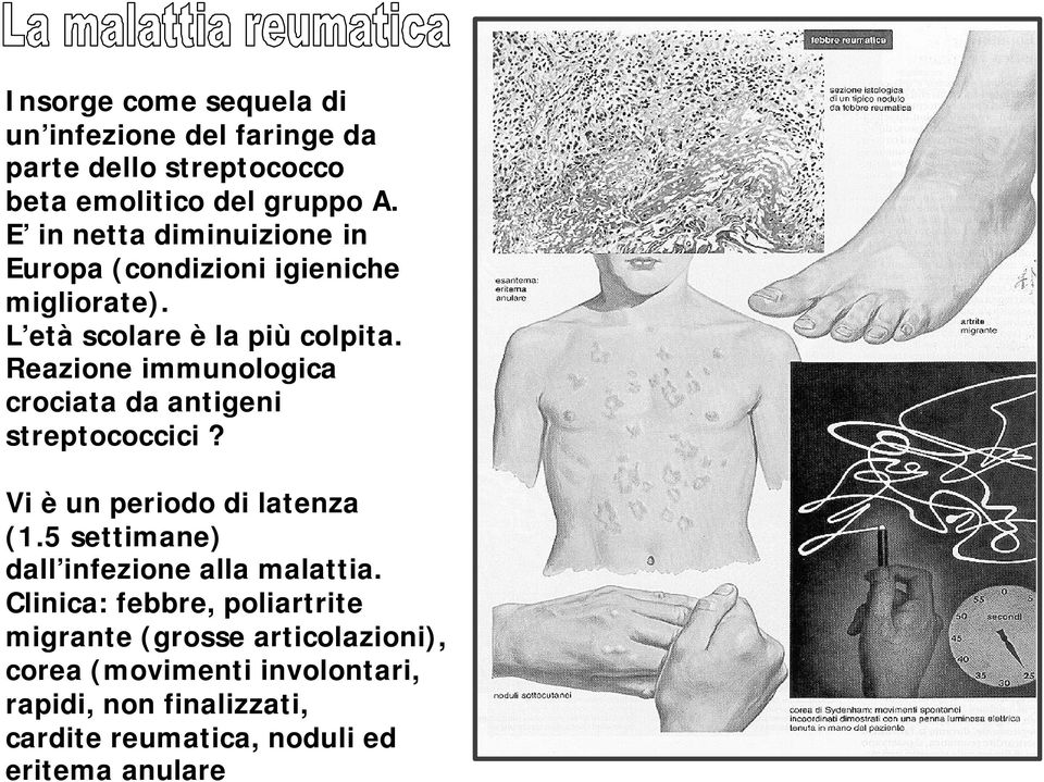 Reazione immunologica crociata da antigeni streptococcici? Vi è un periodo di latenza (1.