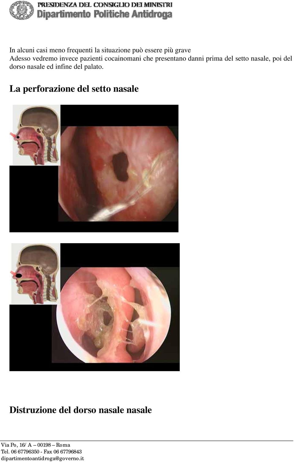 prima del setto nasale, poi del dorso nasale ed infine del palato.