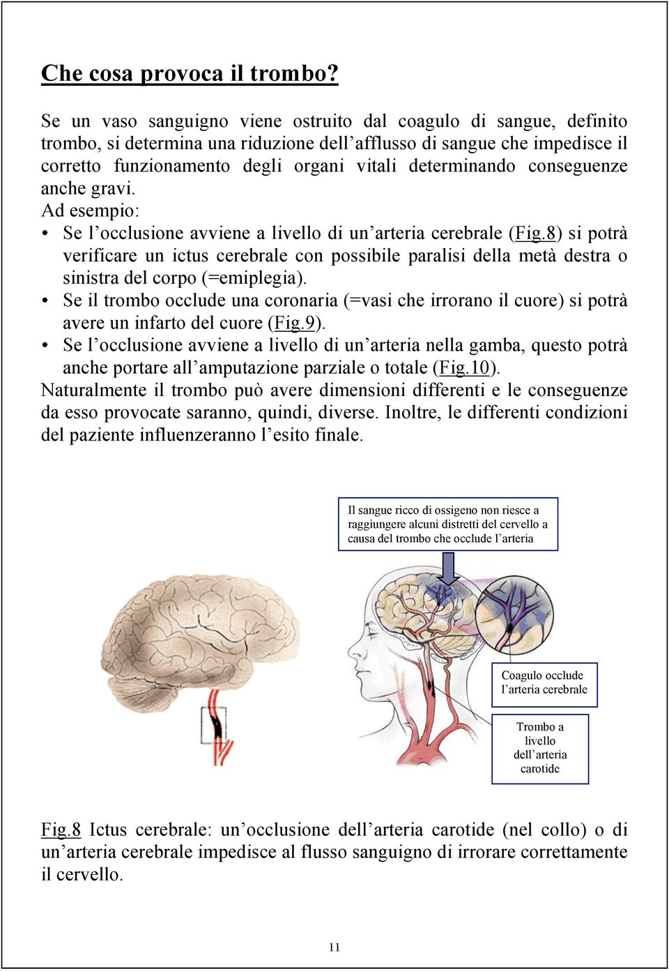 conseguenze anche gravi. Ad esempio: Se l occlusione avviene a livello di un arteria cerebrale (Fig.