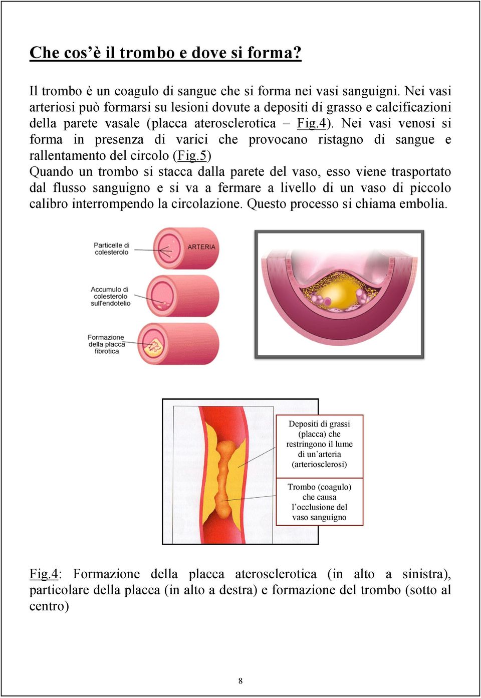 Nei vasi venosi si forma in presenza di varici che provocano ristagno di sangue e rallentamento del circolo (Fig.