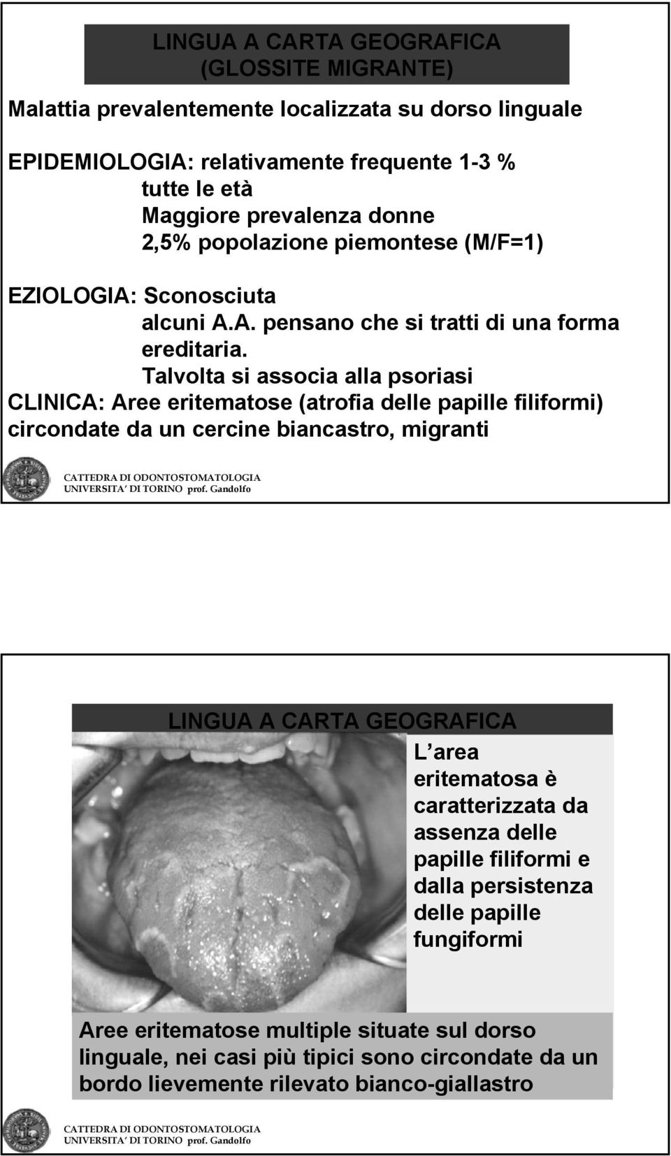 Talvolta si associa alla psoriasi CLINICA: Aree eritematose (atrofia delle papille filiformi) circondate da un cercine biancastro, migranti LINGUA A CARTA GEOGRAFICA L area