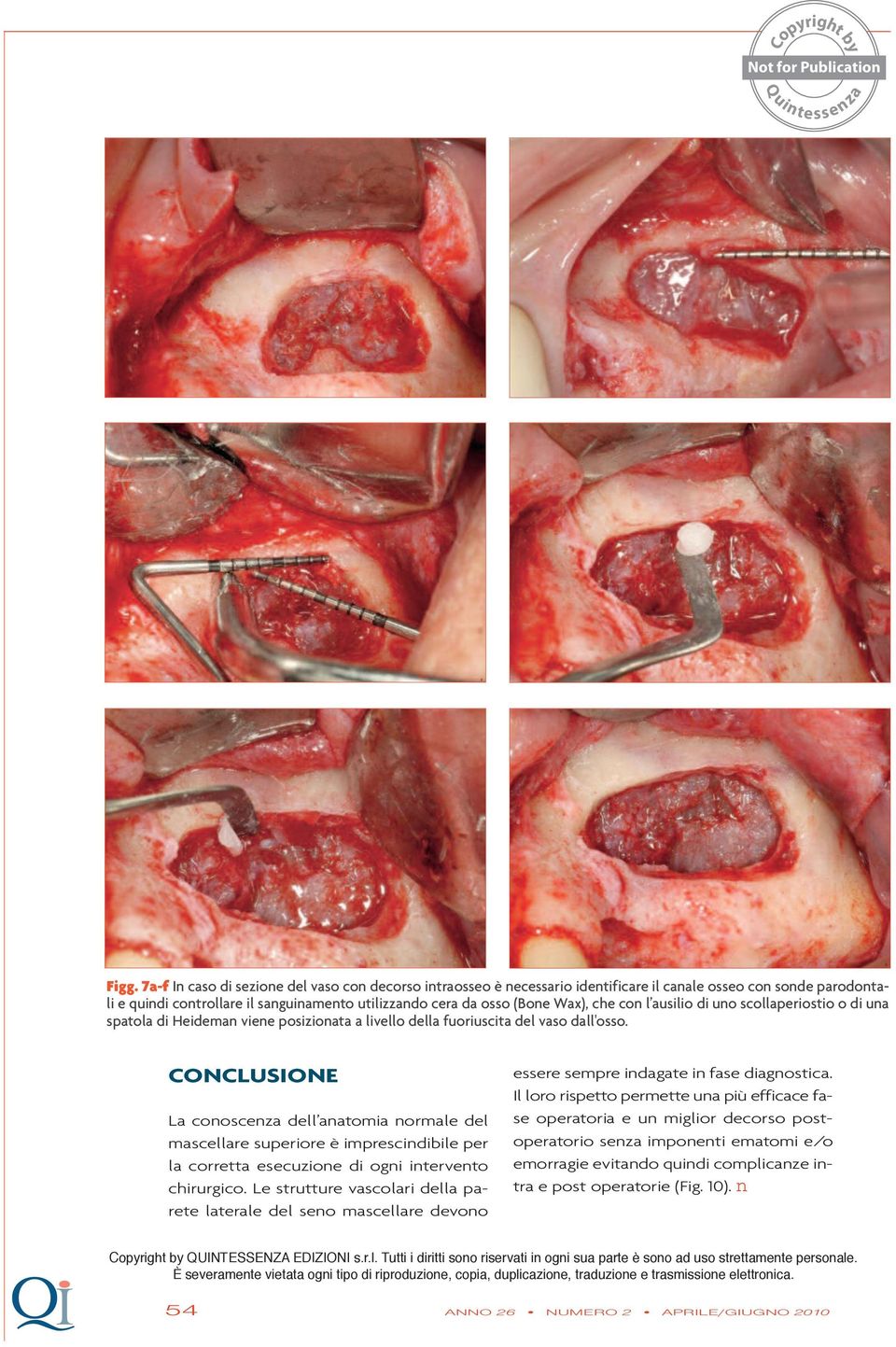 CONCLUSIONE La conoscenza dell anatomia normale del mascellare superiore è imprescindibile per la corretta esecuzione di ogni intervento chirurgico.