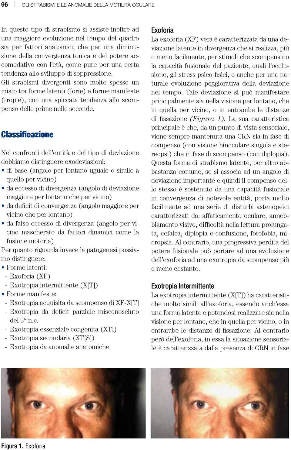 Gli strabismi divergenti sono molto spesso un misto tra forme latenti (forie) e forme manifeste (tropie), con una spiccata tendenza allo scompenso delle prime nelle seconde.