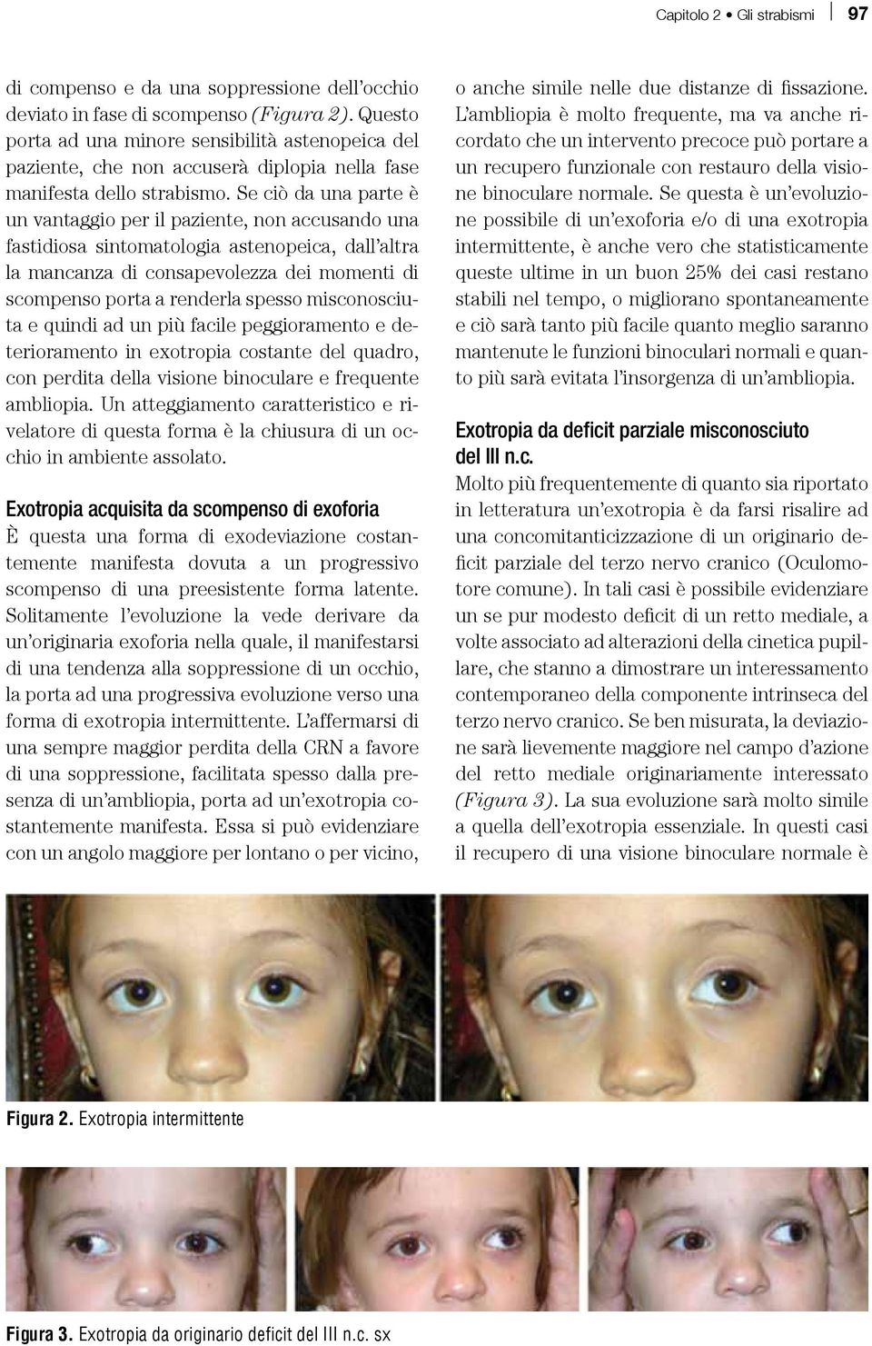 Se ciò da una parte è un vantaggio per il paziente, non accusando una fastidiosa sintomatologia astenopeica, dall altra la mancanza di consapevolezza dei momenti di scompenso porta a renderla spesso