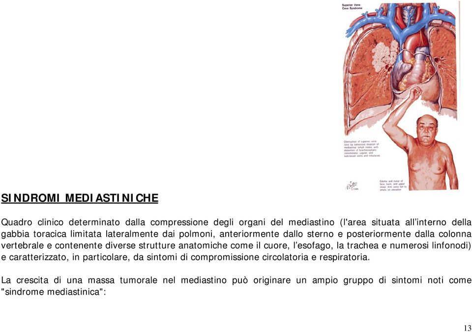 strutture anatomiche come il cuore, l esofago, la trachea e numerosi linfonodi) e caratterizzato, in particolare, da sintomi di compromissione