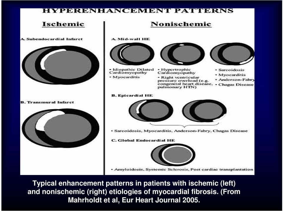 (right) etiologies of myocardial fibrosis.