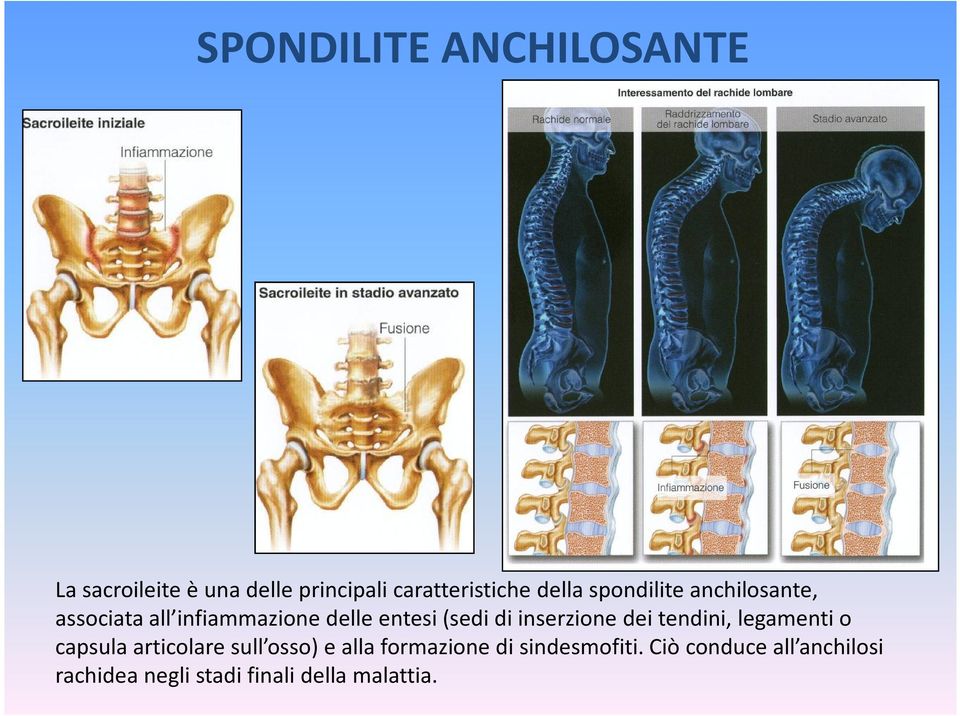 inserzione dei tendini, legamenti o capsula articolare sull osso) e alla