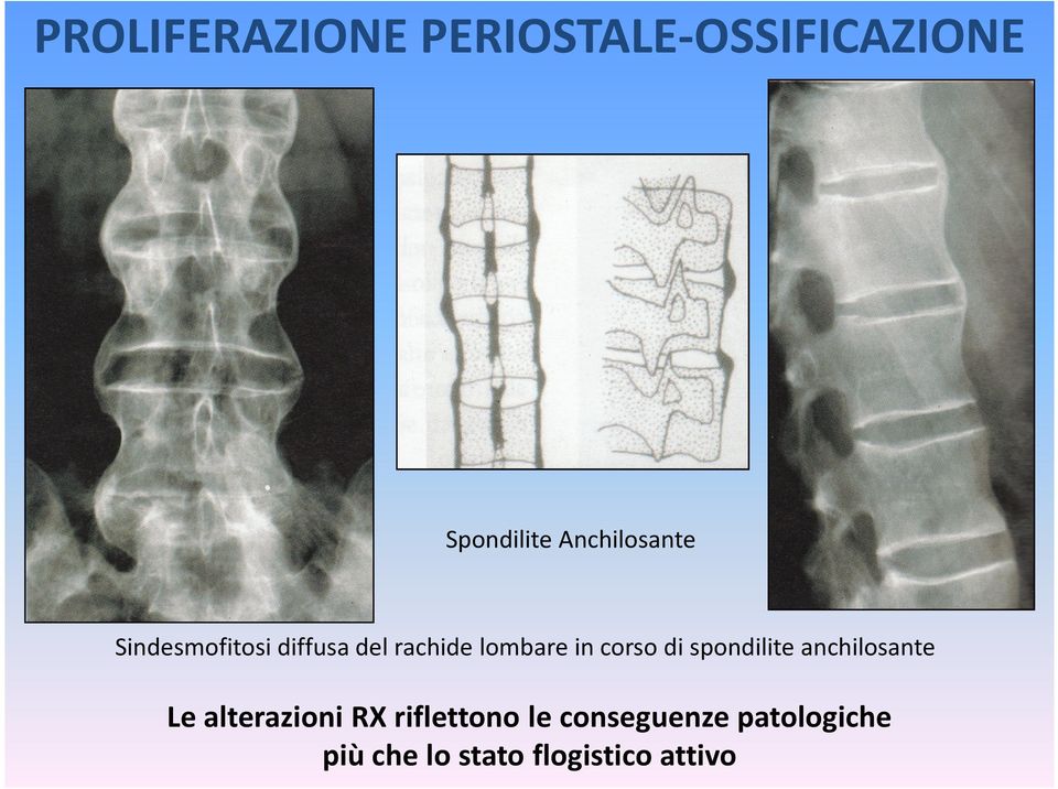 corso di spondilite anchilosante Le alterazioni RX