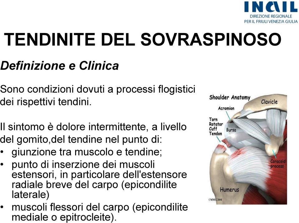 Il sintomo è dolore intermittente, a livello del gomito,del tendine nel punto di: giunzione tra muscolo